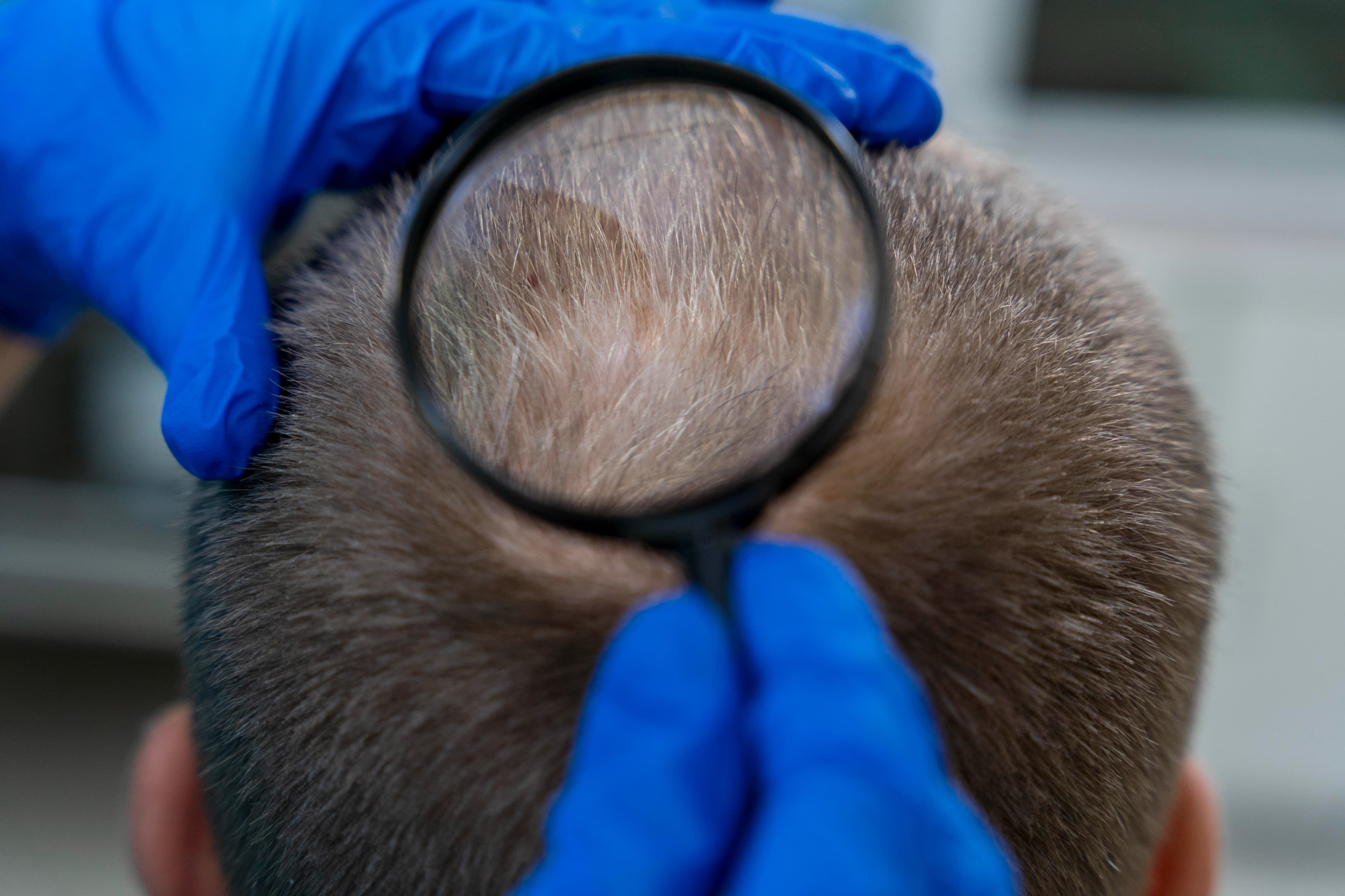 Exosome For Hair Loss treatment