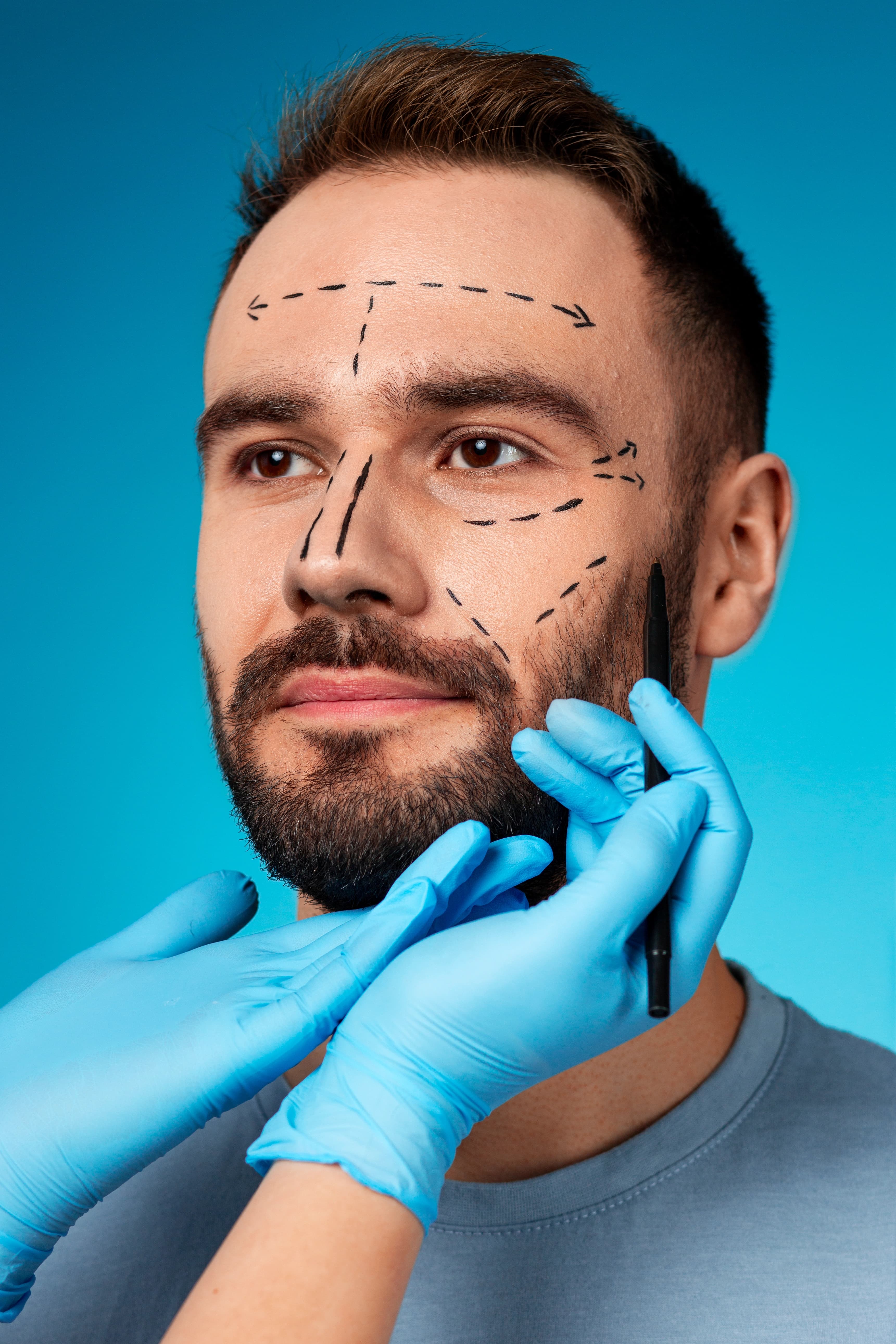 Facial Hair Replacement treatment