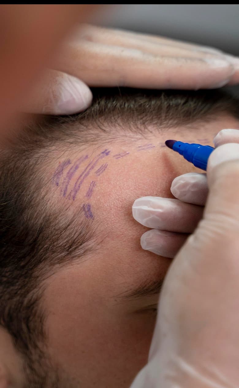 Hair Transplant Procedure