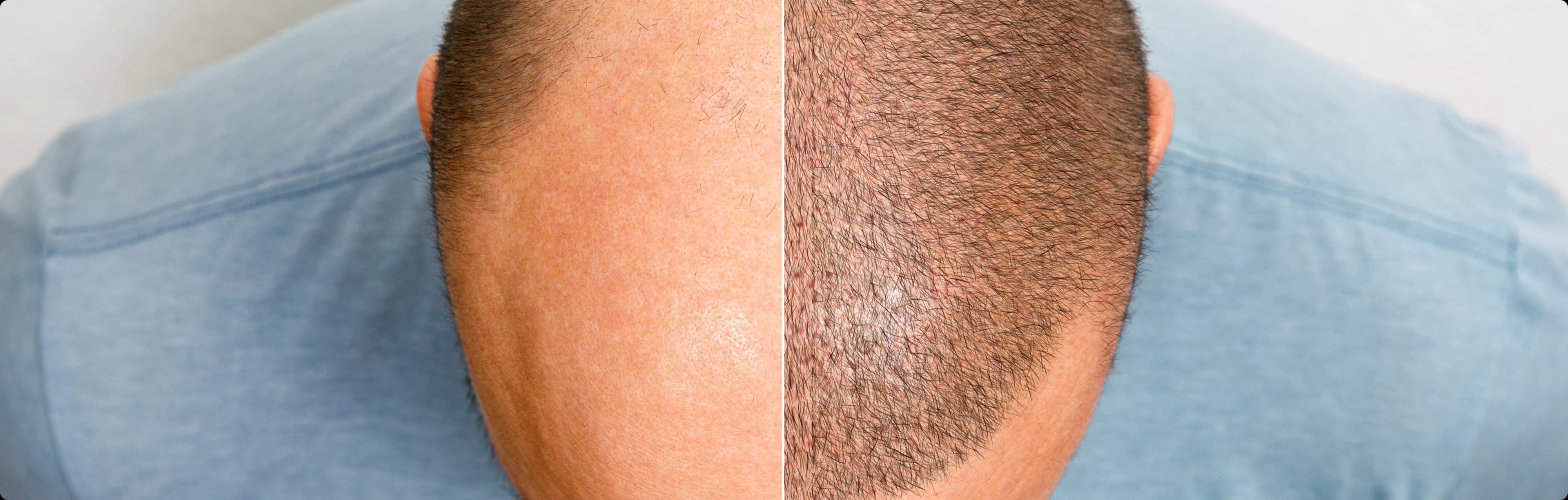 Custom Hairline Design