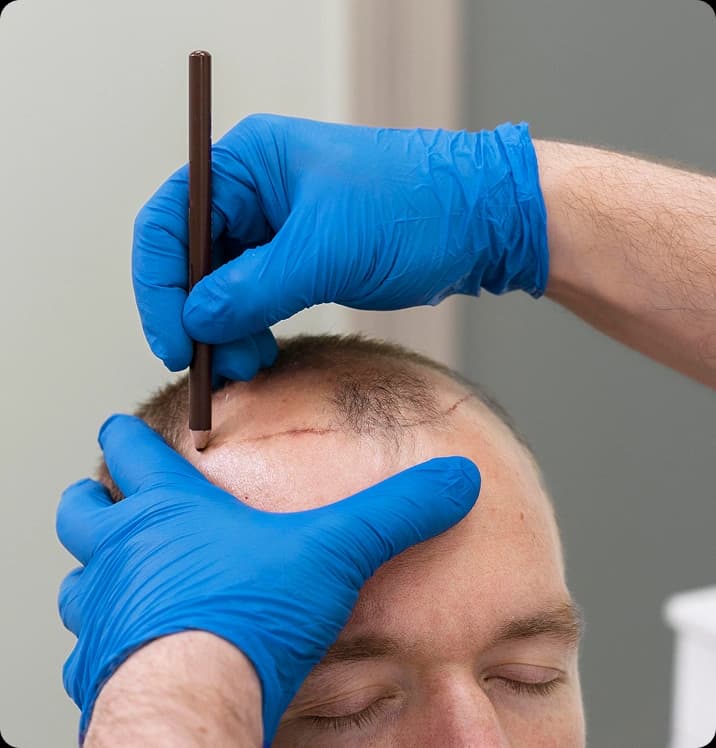 Hair Transplant Results