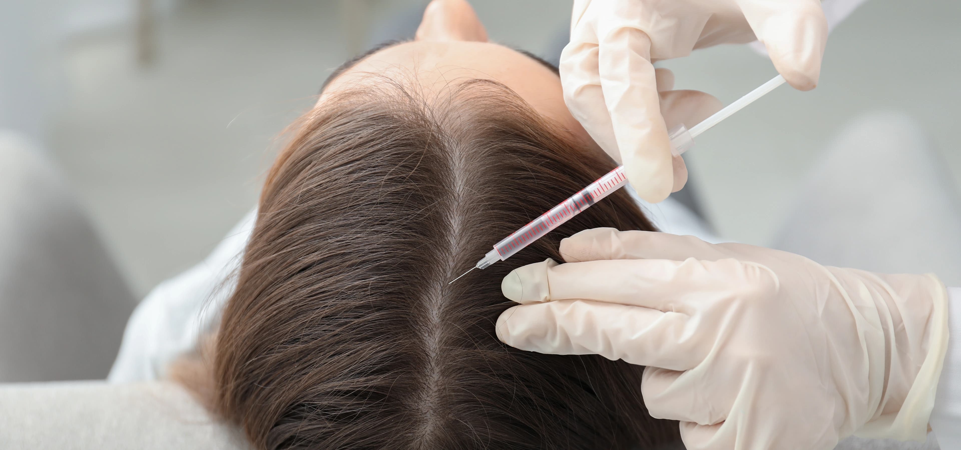 PRP Hair Treatment