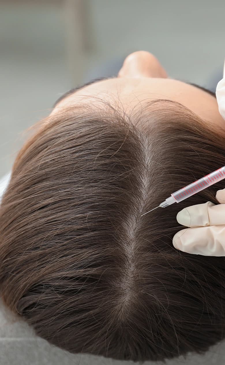 PRP Hair Treatment