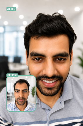 Berkowits Jayanagar hair replacement before and after result 2