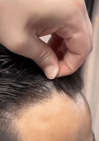 Non-surgical hair replacement result at Berkowits Jayanagar, Bengaluru