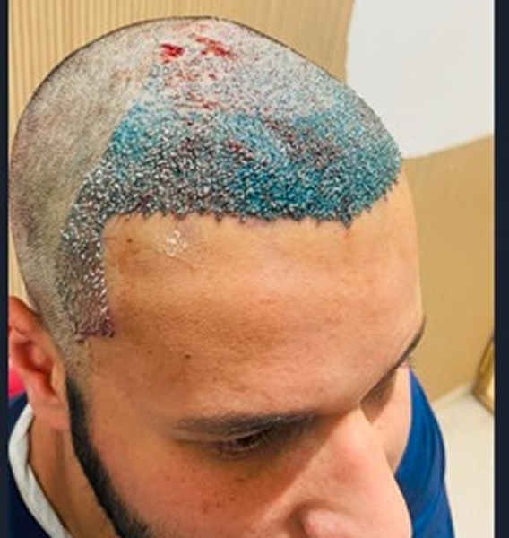 Hair transplant result at Berkowits Borivali