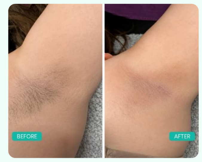 Underarm laser hair reduction before and after result — Berkowits Faridabad