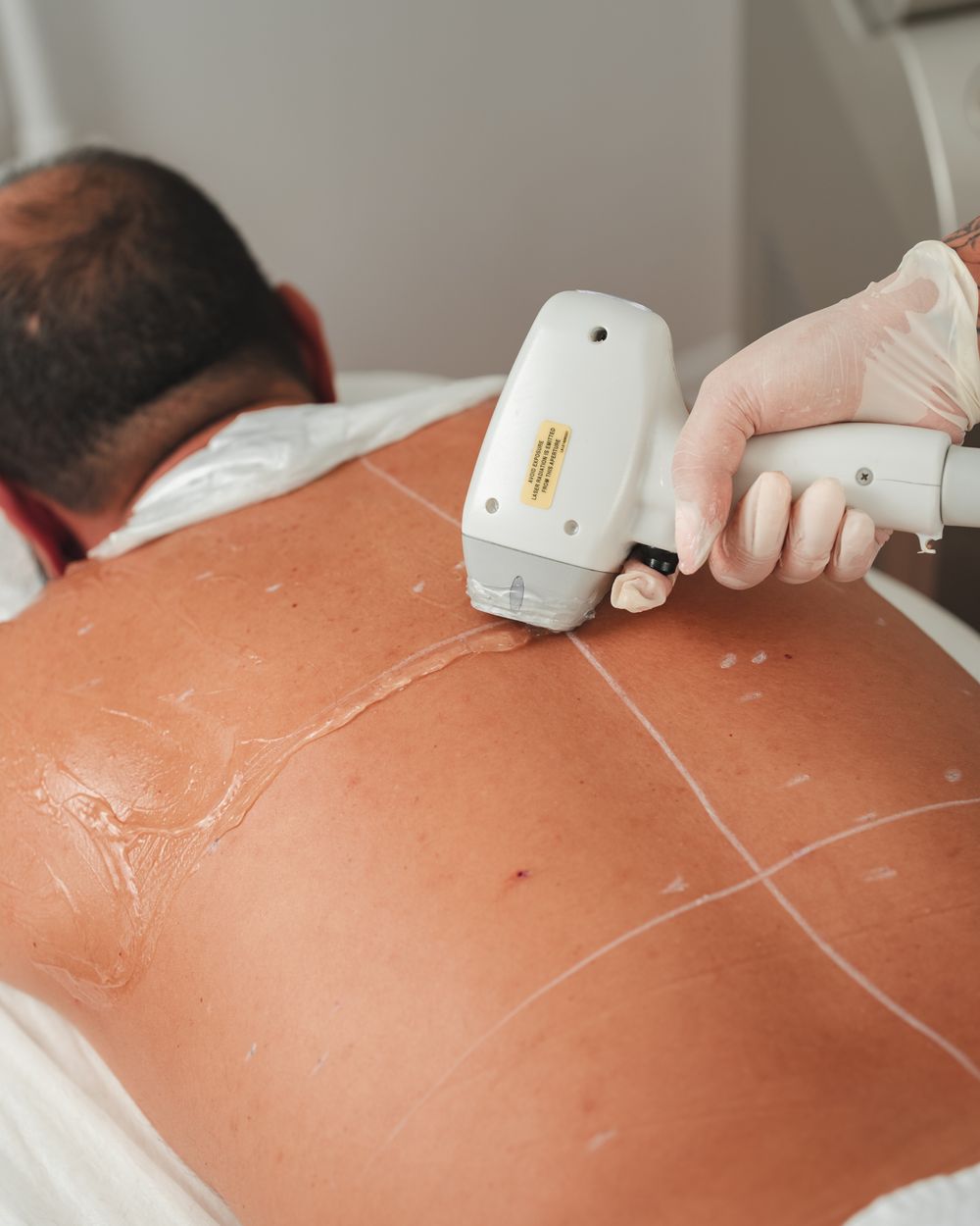 Laser hair reduction for men at Berkowits Faridabad